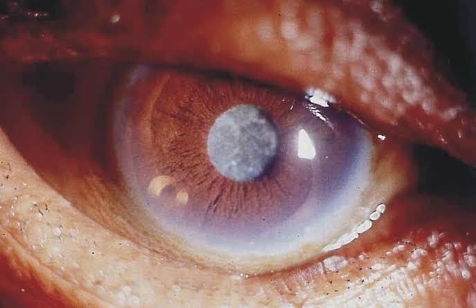 FAQ - Qué debes saber antes y después de la cirugía de cataratas