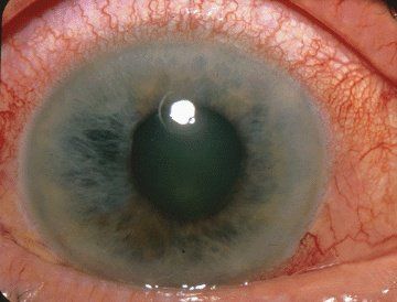 Conoce los síntomas del glaucoma