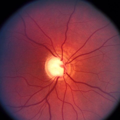 Cirugías de Glaucoma y Cataratas