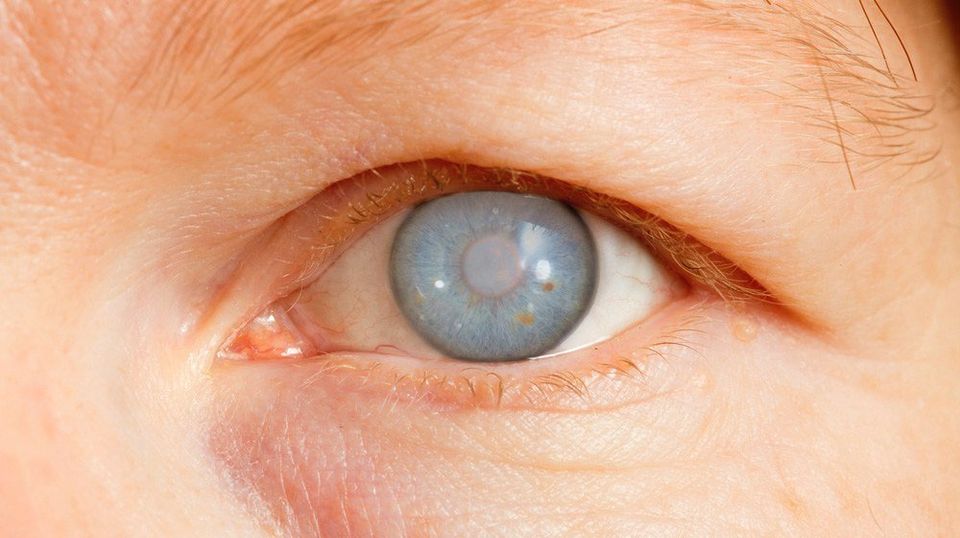 ¿Qué es el glaucoma?