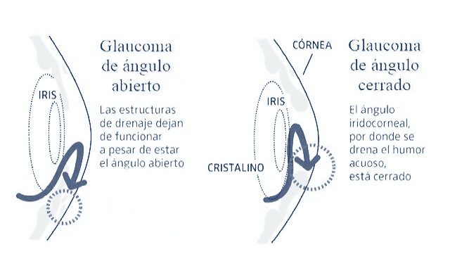 Los dos tipos de glaucoma más comunes