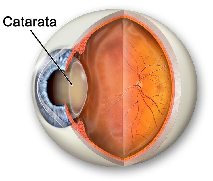 Cataratas: Lo que debe de saber