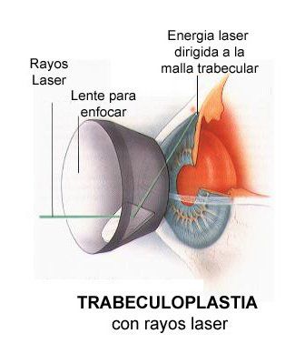 TRABECULOPLASTIA SELECTIVA LÁSER TRABECULOPLASTIA SELECTIVA LÁSER