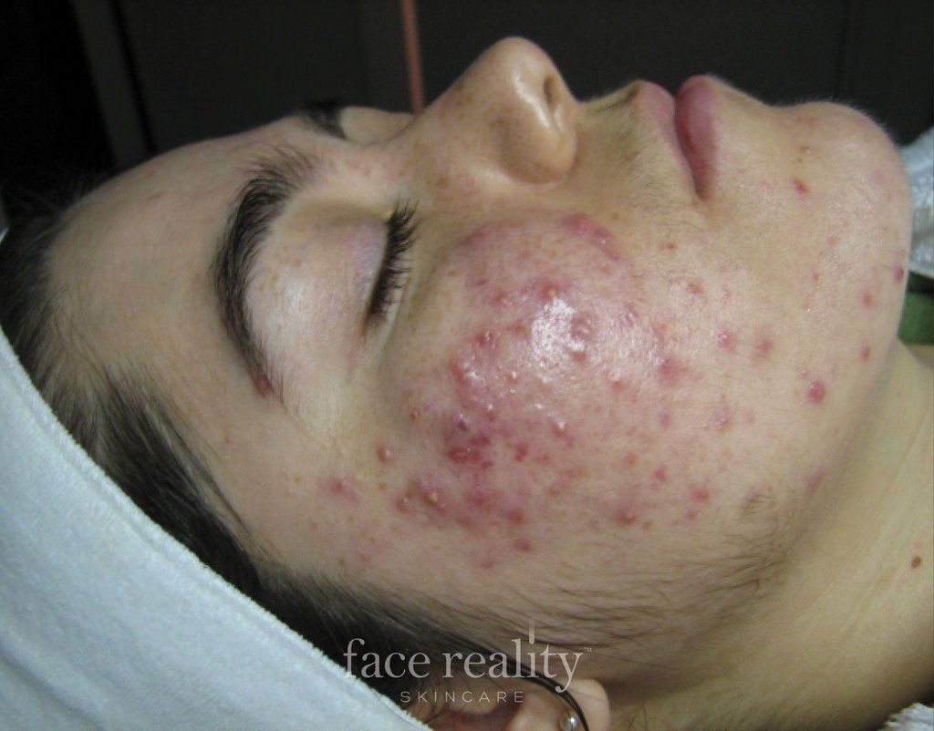 acne treatments, acne skin care, facials, face reality