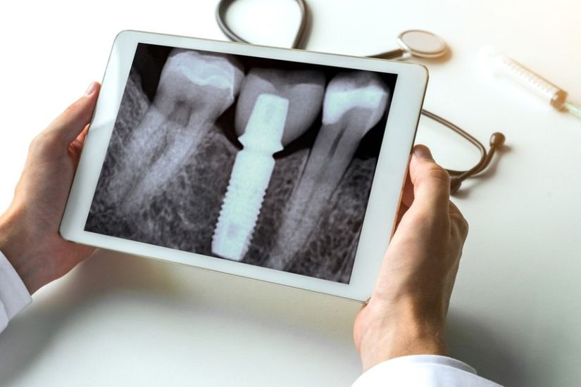 radiografia dentale di un dente con impianto