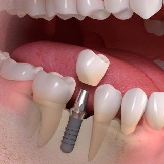 protesi per dente