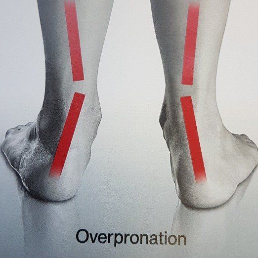 Over-pronation