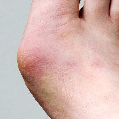 Bunions