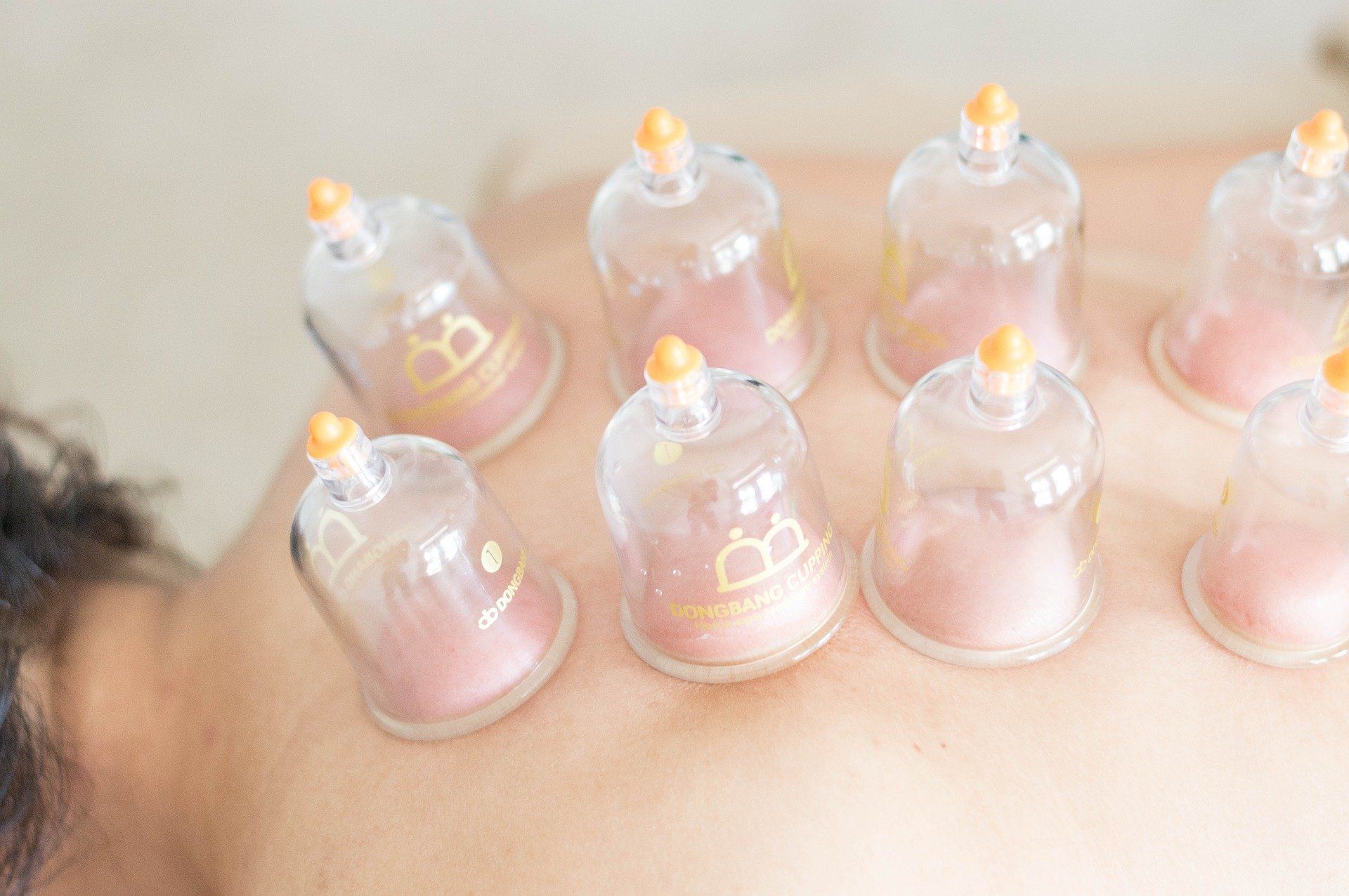 Cupping Therapy Cupping Therapy