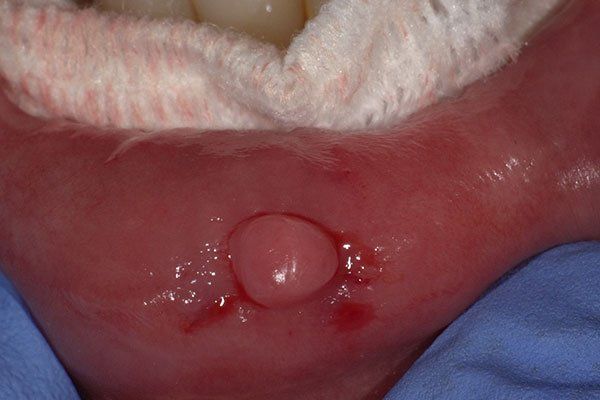 FIBROMA PRE