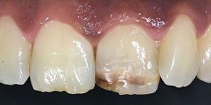 sbiancamento denti