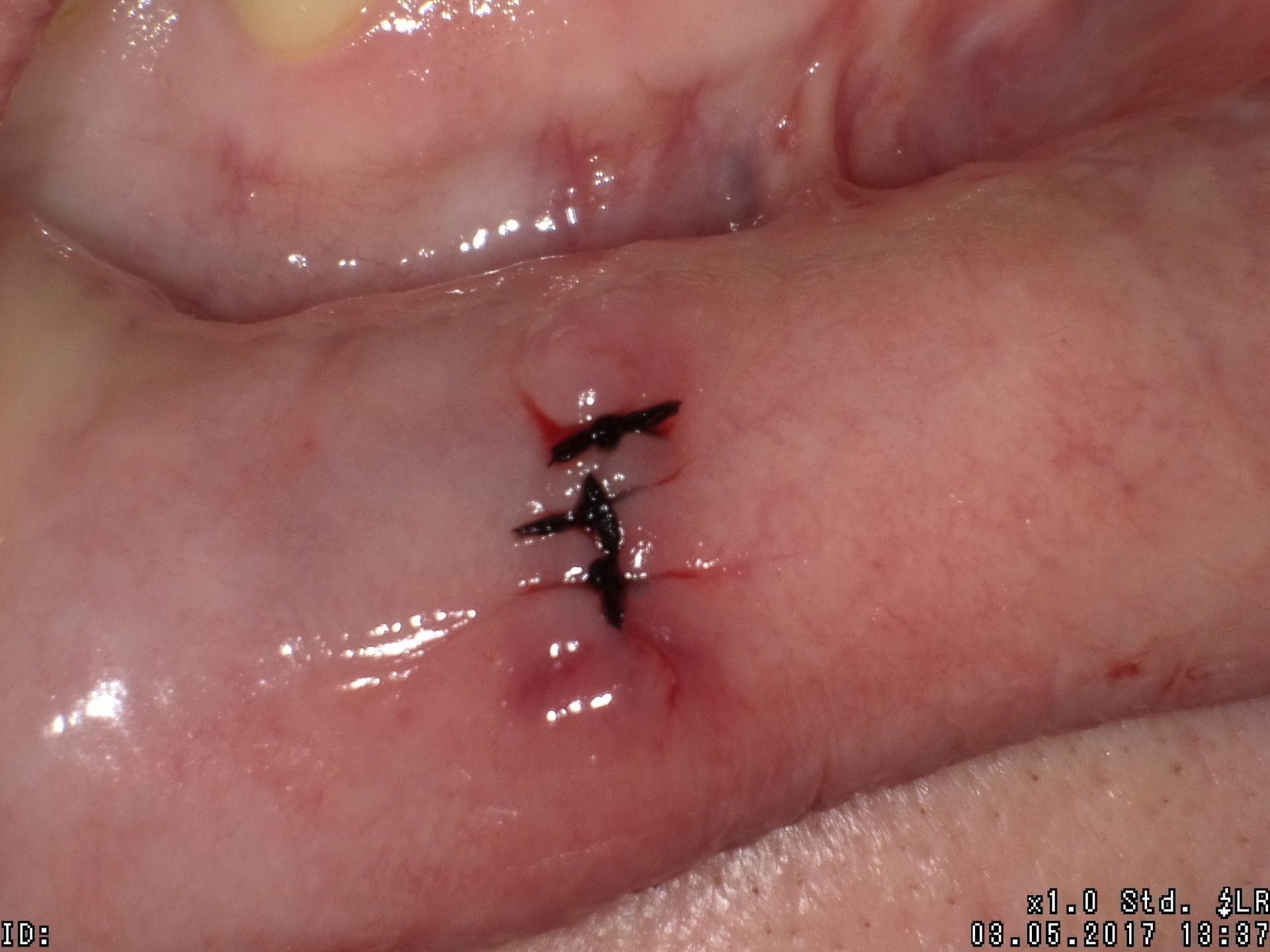 FIBROMA POST