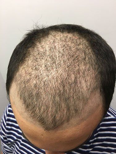 Hair replacement fitting and techniques