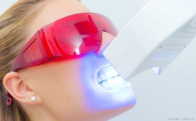 Aktivierung des Bleaching-Gels beim Power-Bleaching. Durch das Licht wird die Bleaching-Wirkung verstärkt. Aktivierung des Bleaching-Gels beim Power-Bleaching. Durch das Licht wird die Bleaching-Wirkung verstärkt.