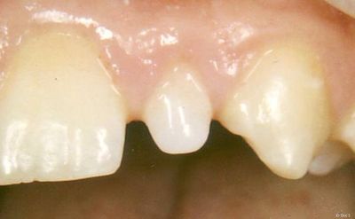 Zahn mit fehlender Schaufelform Zahn mit fehlender Schaufelform