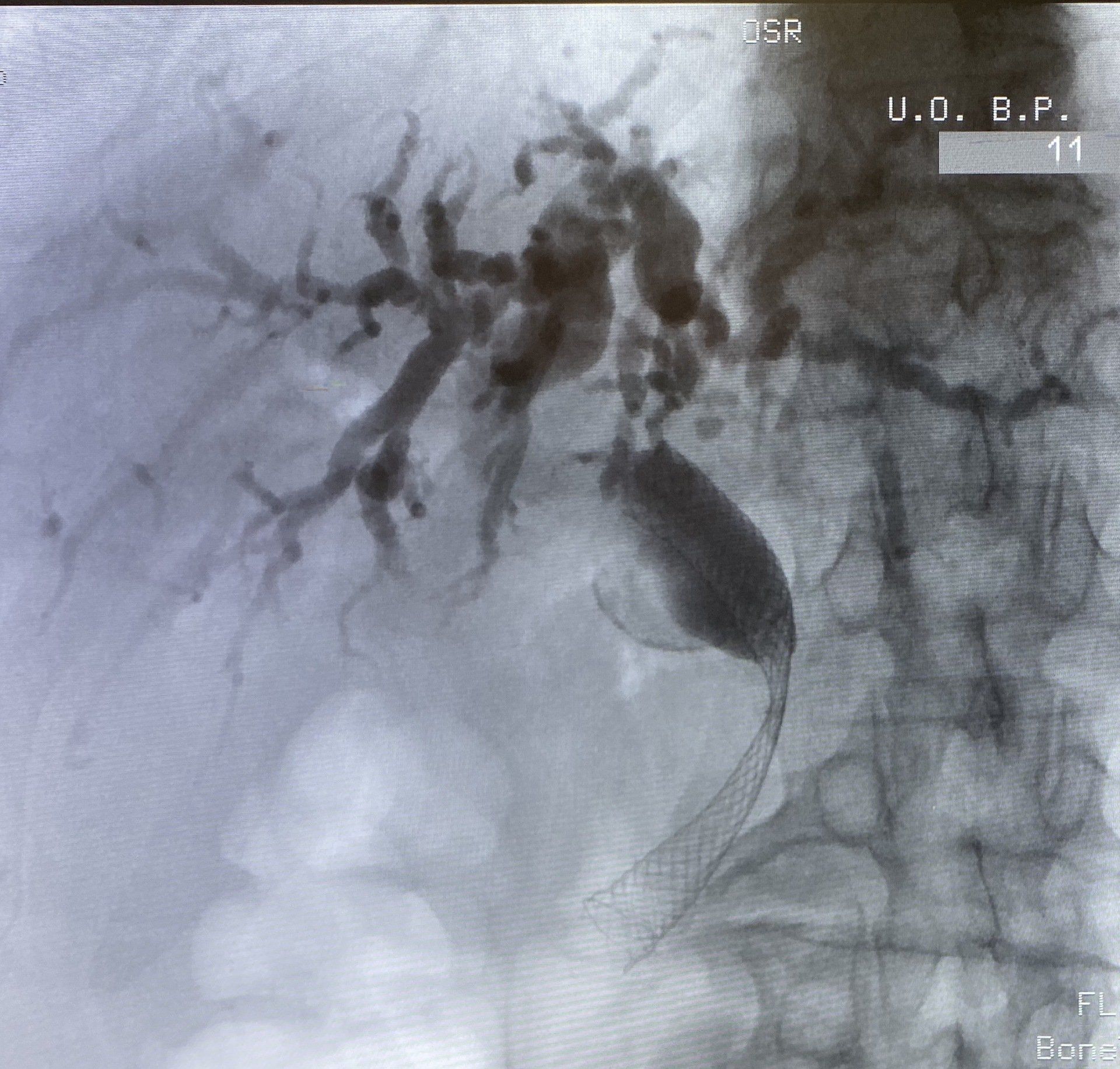 Advanced ERCP Procedure, Endoscopic MRI image