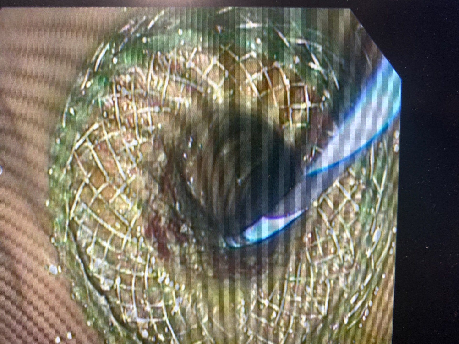 Internalized Draning Medical Procedure, Endoscope image