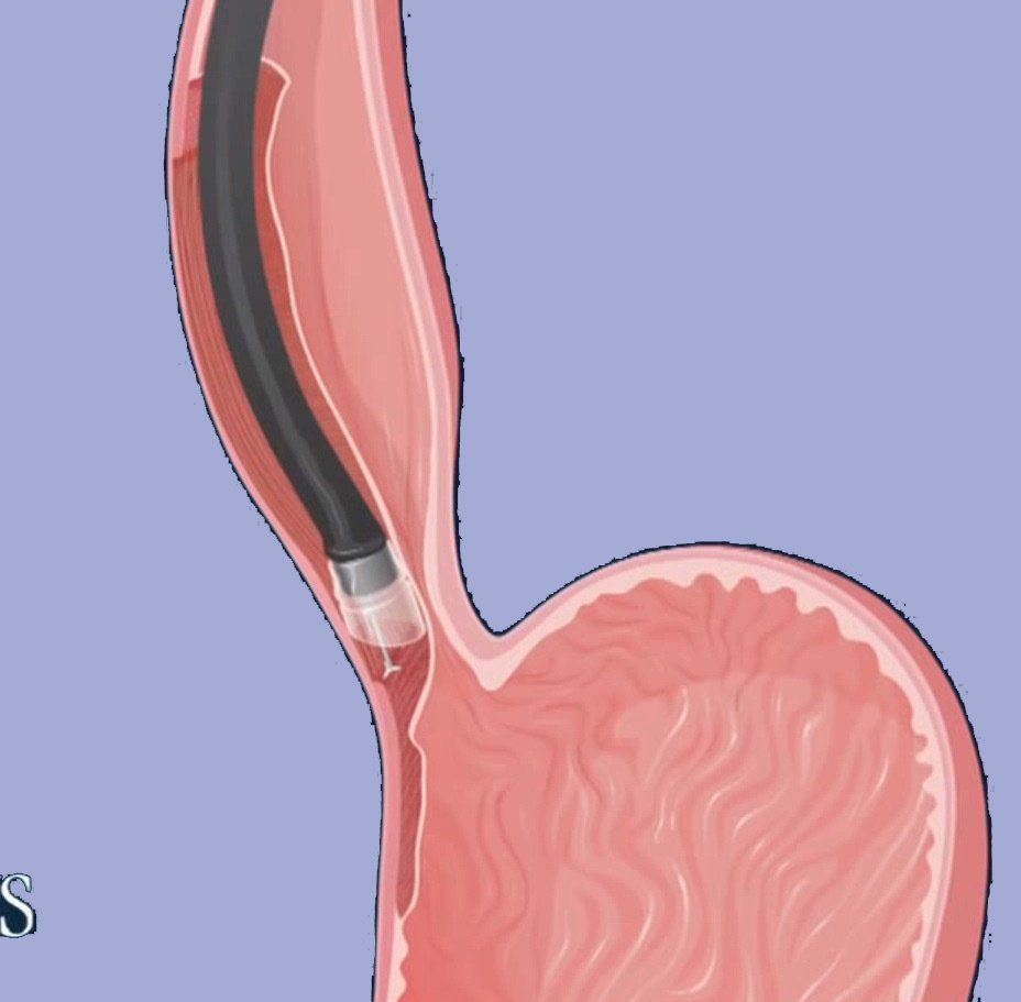 POEM Diagram or Endocope in GI tract