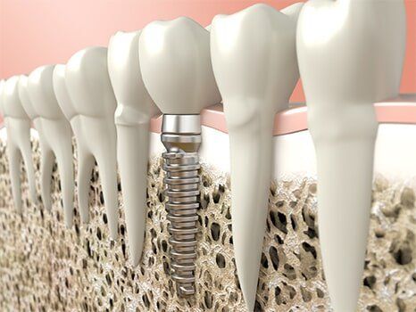 Dental Implant - Family Dentist in Williamstown, NJ Dental Implant - Family Dentist in Williamstown, NJ