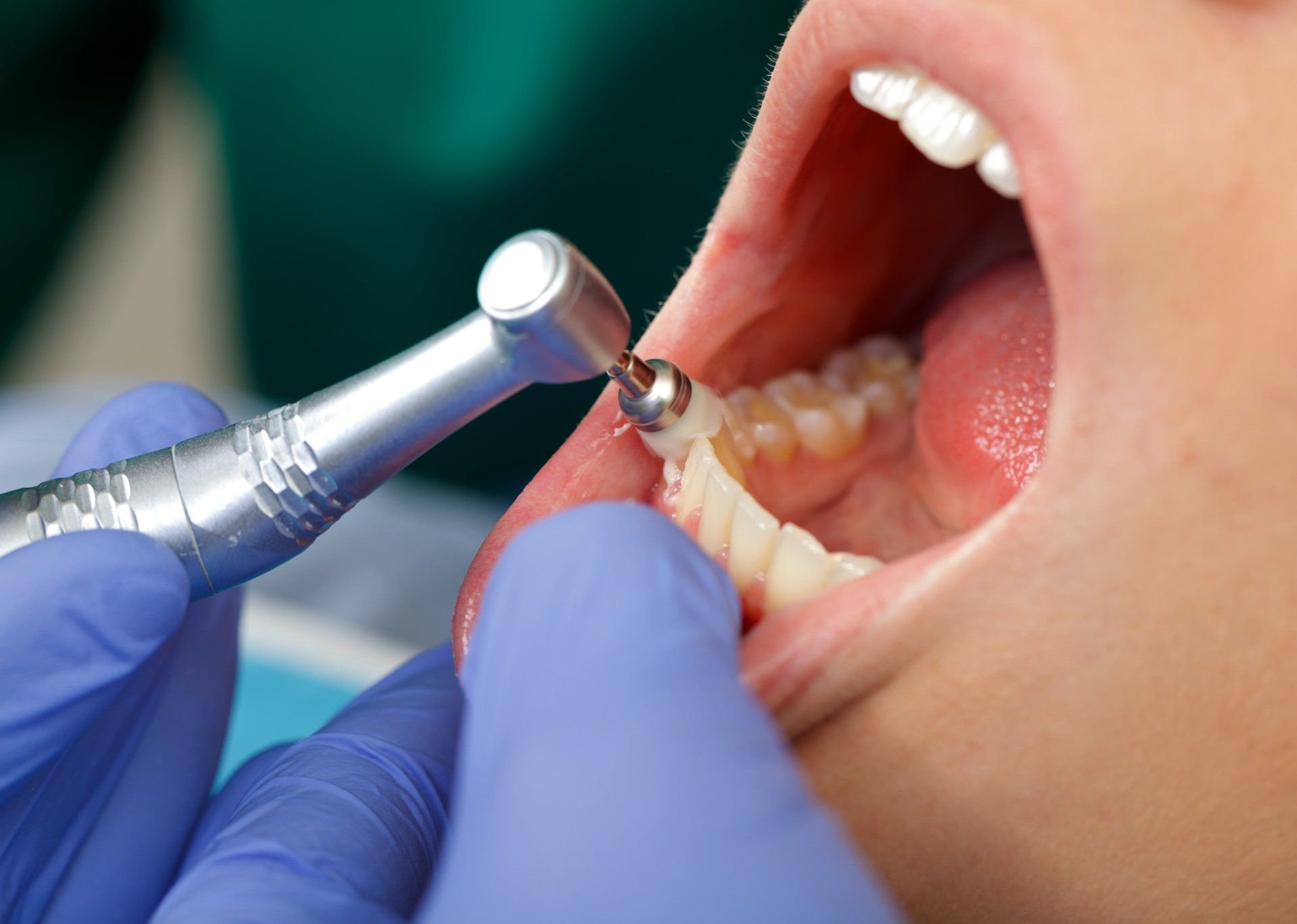 Children Dental Cleaning — Professional Dental Brushing in Statesville, NC