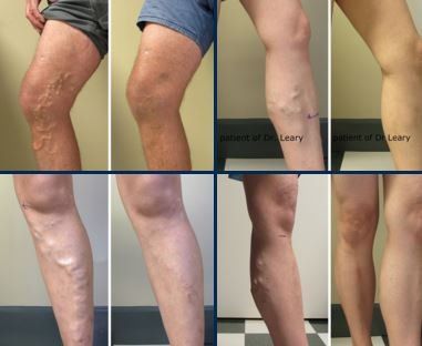 california veins services image california veins services image