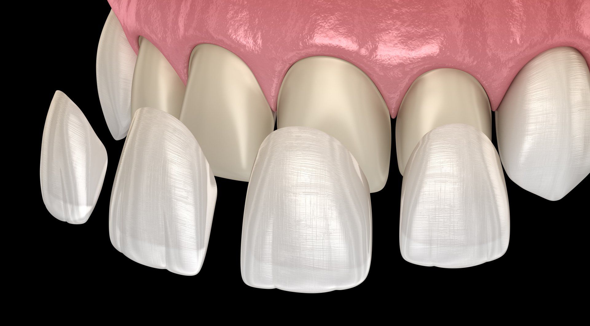 dental vaneers Paphos Dentist