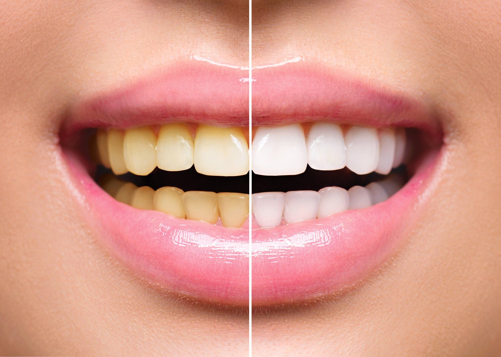 teeth whitening Paphos Dentist