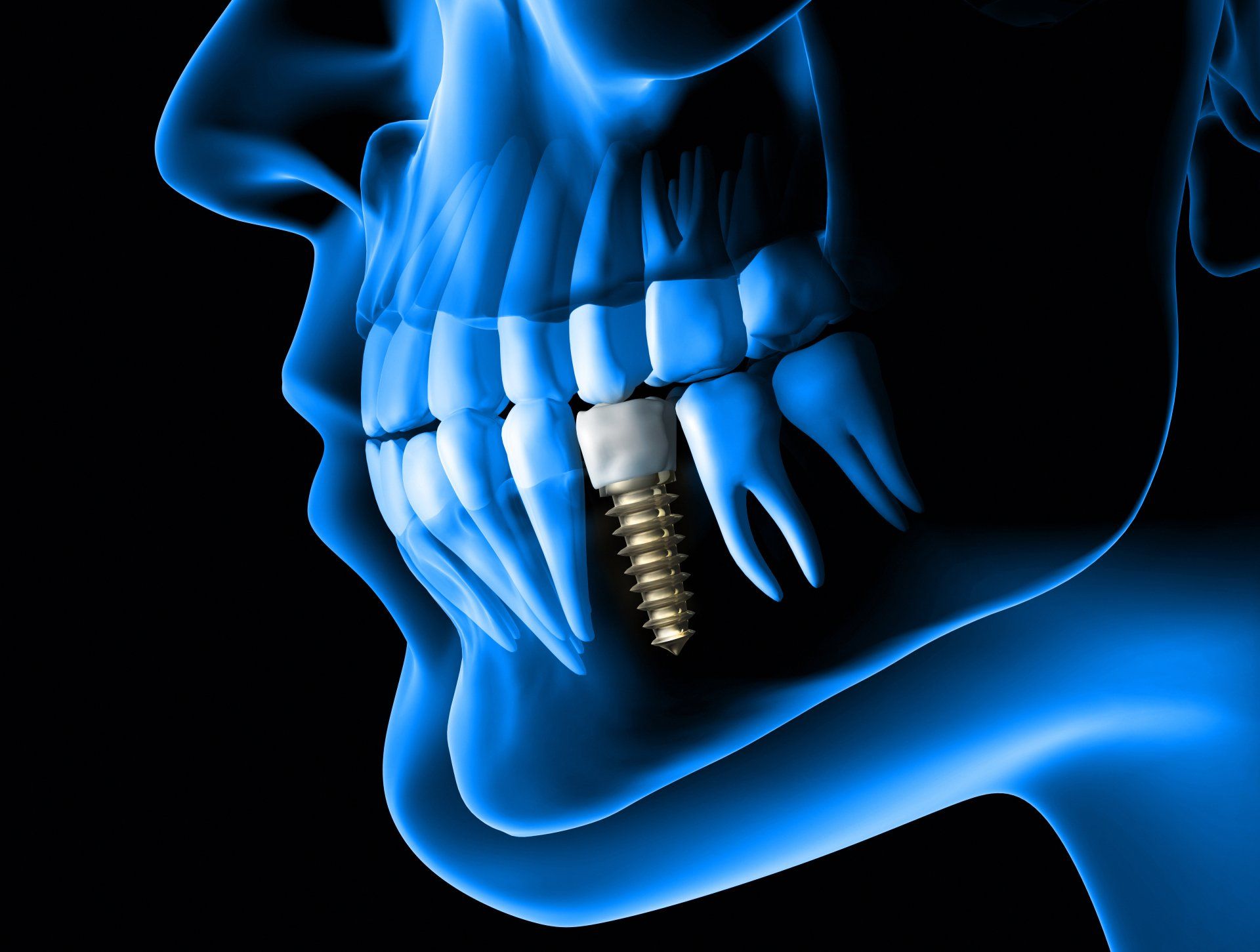 teeth whitening Paphos Dentist