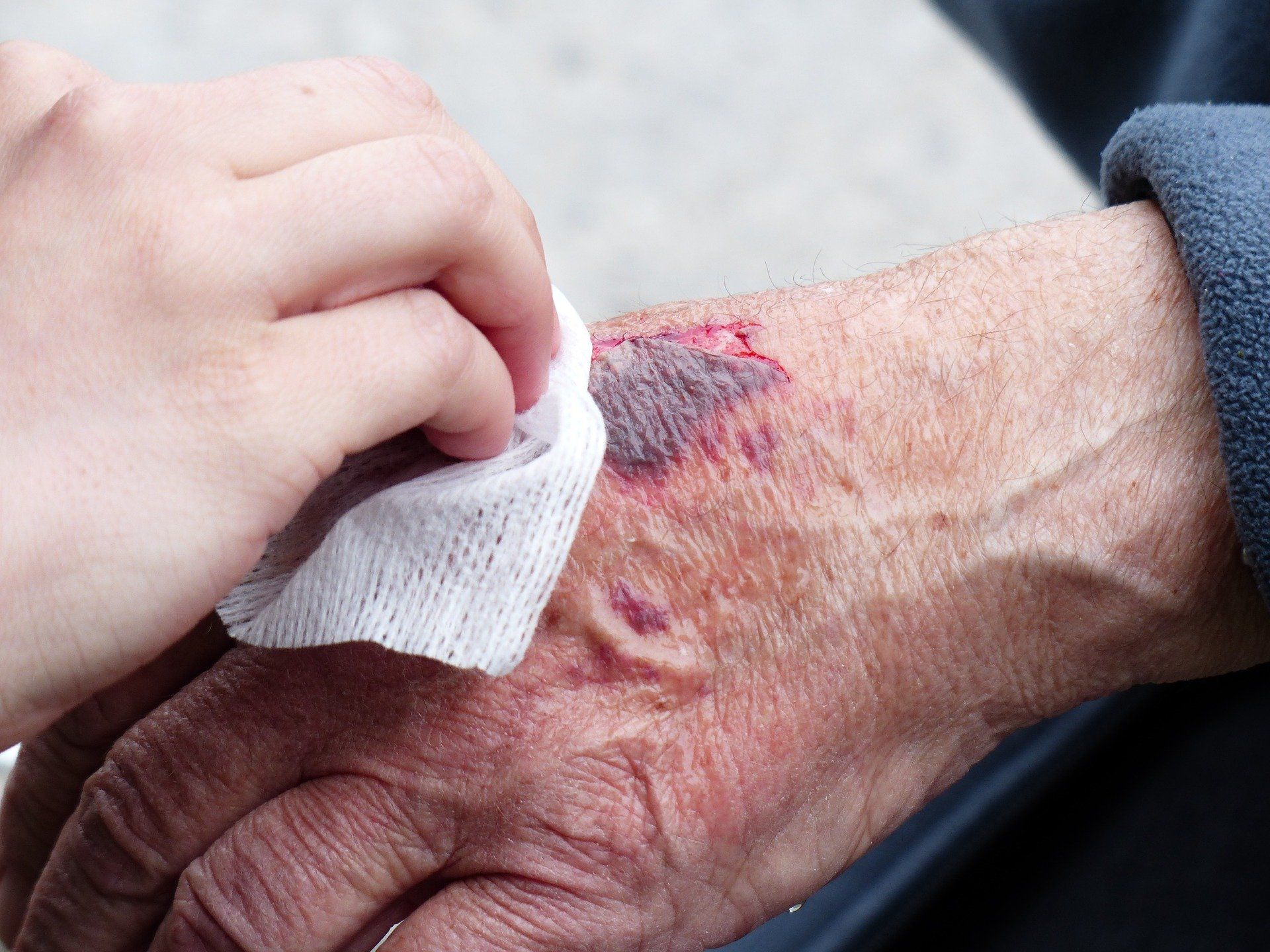 A bandaged hand with a tube coming out of the bandage.