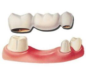 illustration of a dental bridge