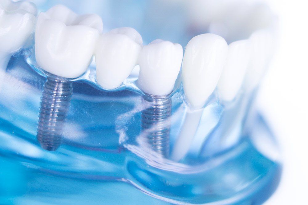 blue model of tooth implants