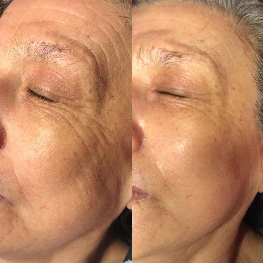 Ein Vorher-Nachher-Foto des Gesichts einer Frau mit geschlossenen Augen.