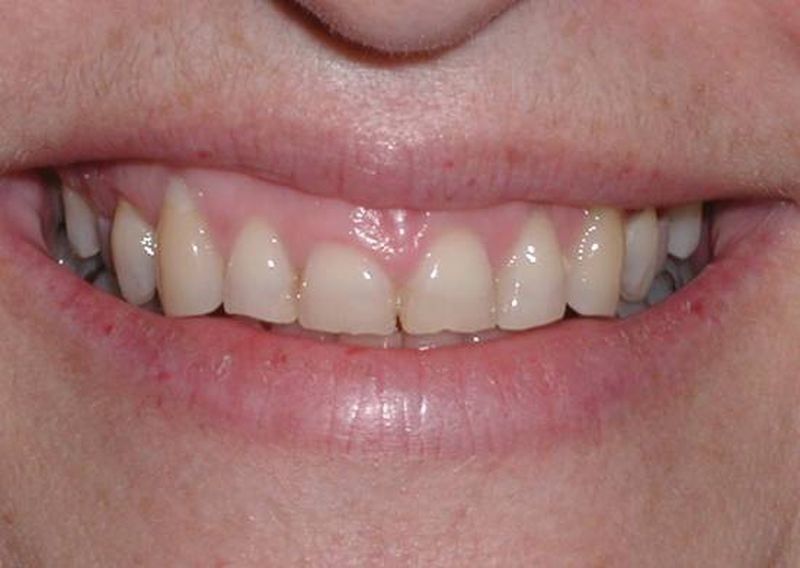 Balboa Dental Clinic - Tratamiento de encías
