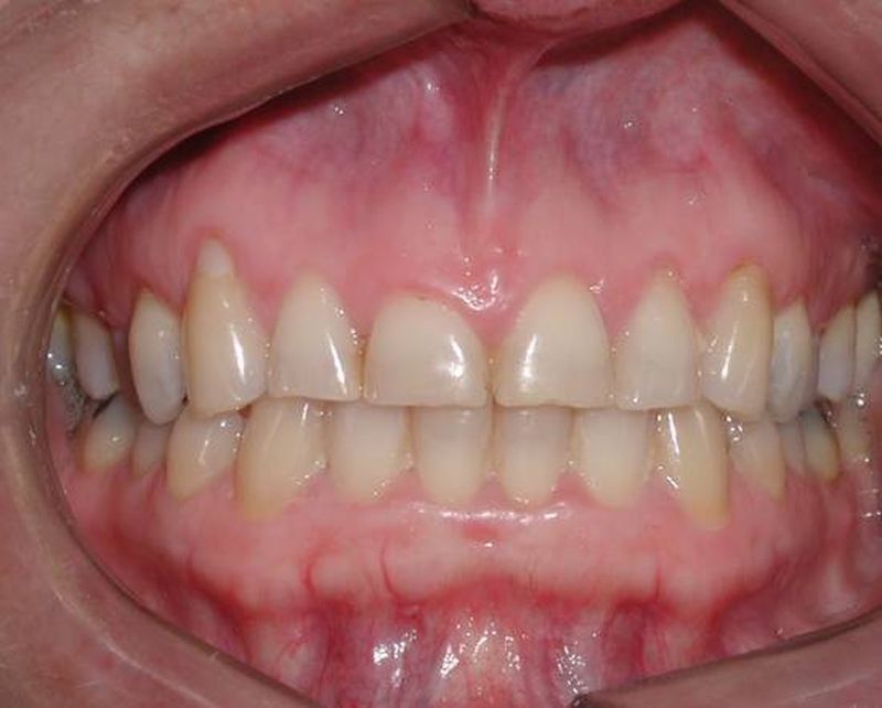 Balboa Dental Clinic - Tratamiento de encías