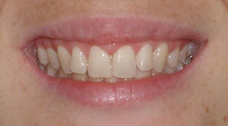 Balboa Dental Clinic - Tratamiento de encías