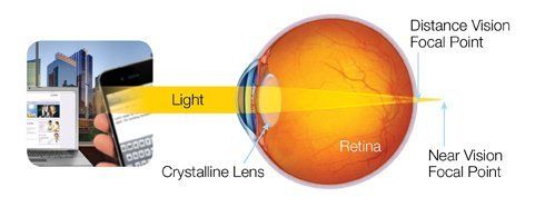 Presbyopia