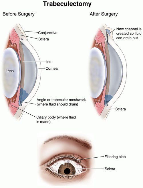 Glaucoma Surgery Ocala & The Villages, FL