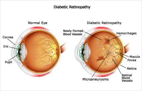 Diabetic Retinopathy