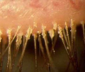 Blepharitis Treatment
