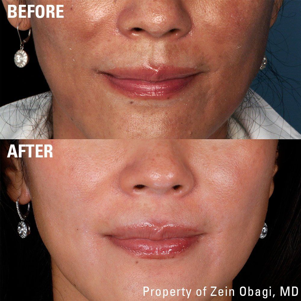 A before and after photo of a woman 's face
