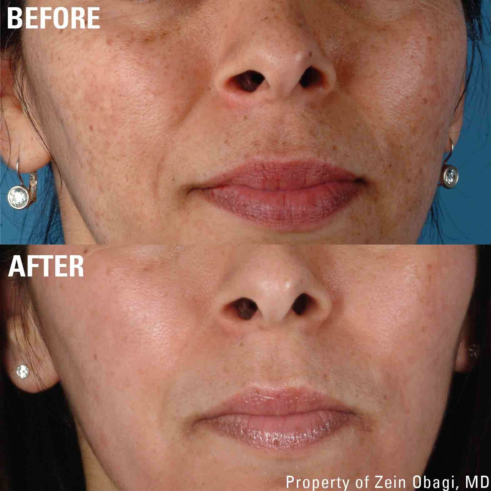 A before and after photo of a woman 's face