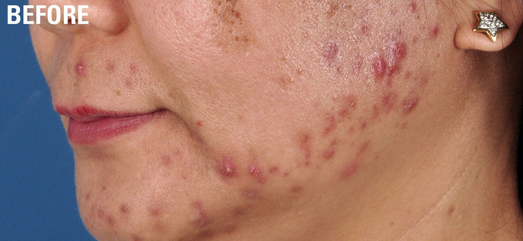 A close up of a woman 's face with acne on it.