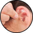 Auricular acupuncture