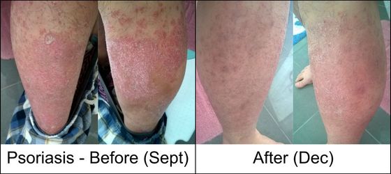Psoriasis treatment