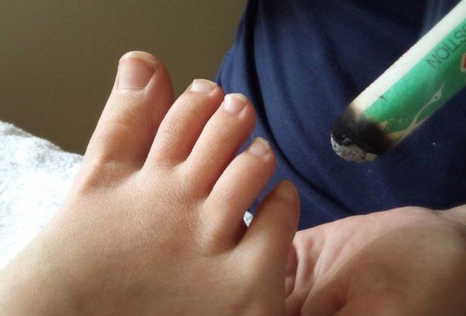 pregnancy acupuncture