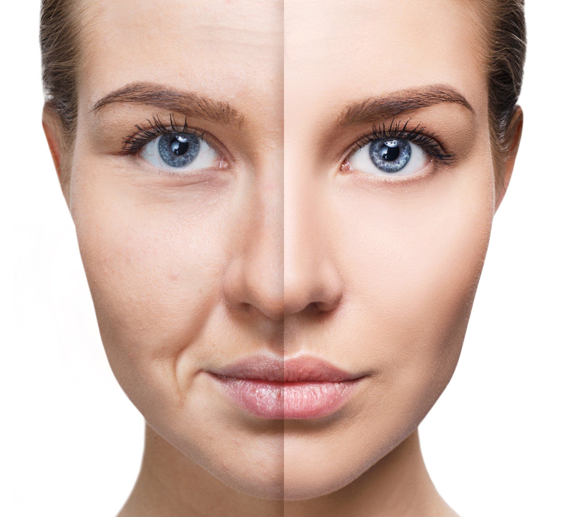 Plasma Lift — Taylor, MI — Taylor Smiles Plasma Lift — Taylor, MI — Taylor Smiles