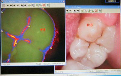 Cavity Detection Device — Taylor, MI — Taylor Smiles Cavity Detection Device — Taylor, MI — Taylor Smiles