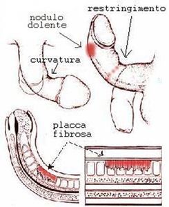 Rappresentazione grafica di pene affetto da Induratio Penis Plastica