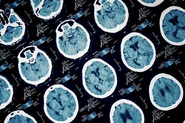 Multiple CT scan cross-sections of the human brain, showing the internal structures in shades of blue and white against a black background.