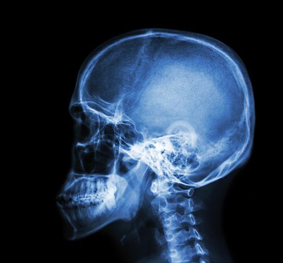 X-ray of a human skull and upper spine in profile, showing the bones in shades of white and blue against a black background.